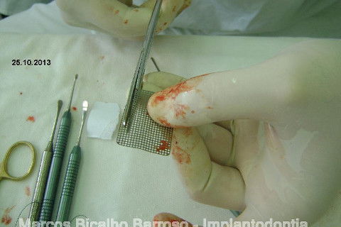 Regeneração Óssea Guiada com Osso Autógeno + Xenógeno + Tela de Titânio