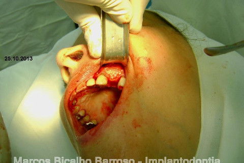 Regeneração Óssea Guiada com Osso Autógeno + Xenógeno + Tela de Titânio