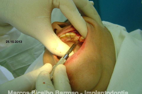 Regeneração Óssea Guiada com Osso Autógeno + Xenógeno + Tela de Titânio