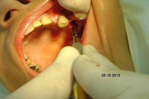 Regeneração Óssea Guiada com Osso Autógeno + Xenógeno + Tela de Titânio