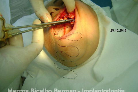 Regeneração Óssea Guiada com Osso Autógeno + Xenógeno + Tela de Titânio
