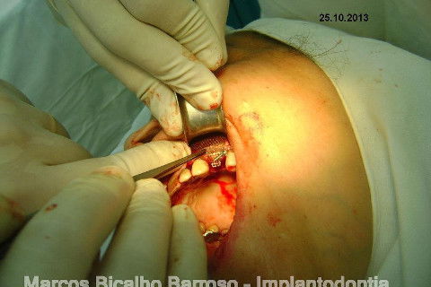 Regeneração Óssea Guiada com Osso Autógeno + Xenógeno + Tela de Titânio