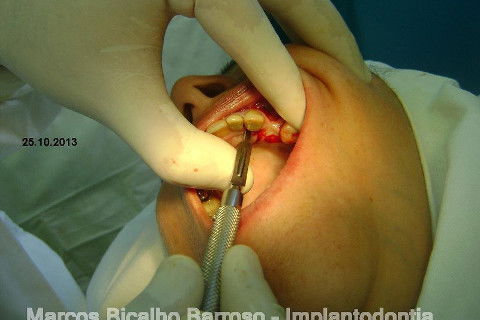 Regeneração Óssea Guiada com Osso Autógeno + Xenógeno + Tela de Titânio