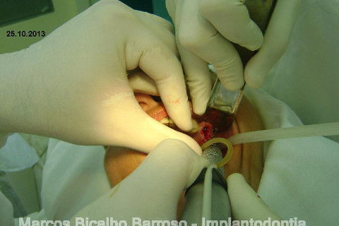 Regeneração Óssea Guiada com Osso Autógeno + Xenógeno + Tela de Titânio