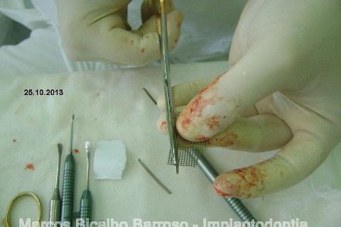 Regeneração Óssea Guiada com Osso Autógeno + Xenógeno + Tela de Titânio