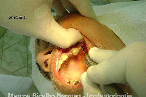 Regeneração Óssea Guiada com Osso Autógeno + Xenógeno + Tela de Titânio