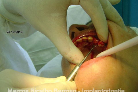 Regeneração Óssea Guiada com Osso Autógeno + Xenógeno + Tela de Titânio