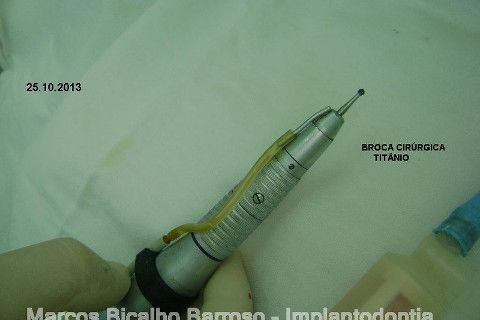 Regeneração Óssea Guiada com Osso Autógeno + Xenógeno + Tela de Titânio