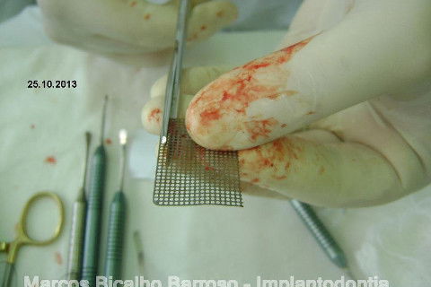 Regeneração Óssea Guiada com Osso Autógeno + Xenógeno + Tela de Titânio