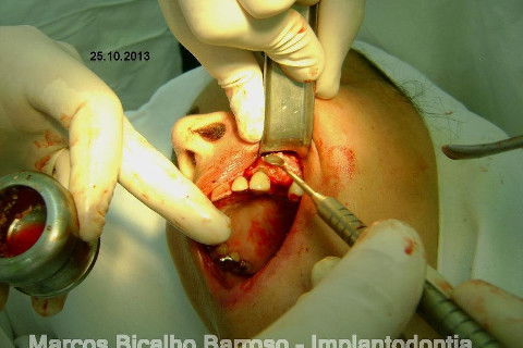 Regeneração Óssea Guiada com Osso Autógeno + Xenógeno + Tela de Titânio