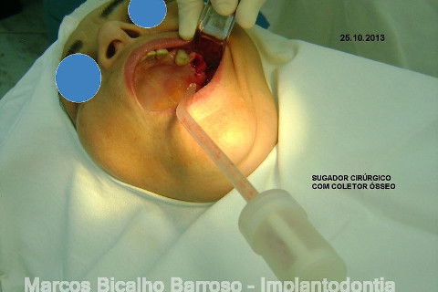 Regeneração Óssea Guiada com Osso Autógeno + Xenógeno + Tela de Titânio
