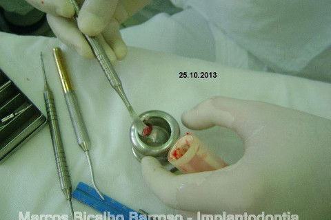 Regeneração Óssea Guiada com Osso Autógeno + Xenógeno + Tela de Titânio