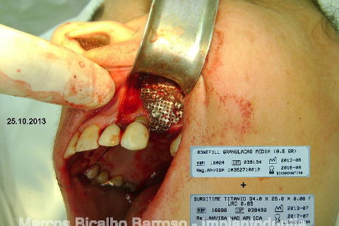 Regeneração Óssea Guiada com Osso Autógeno + Xenógeno + Tela de Titânio
