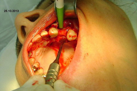 Regeneração Óssea Guiada com Osso Autógeno + Xenógeno + Tela de Titânio
