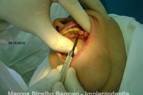 Regeneração Óssea Guiada com Osso Autógeno + Xenógeno + Tela de Titânio