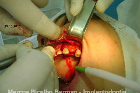 Regeneração Óssea Guiada com Osso Autógeno + Xenógeno + Tela de Titânio