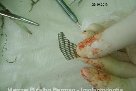 Regeneração Óssea Guiada com Osso Autógeno + Xenógeno + Tela de Titânio