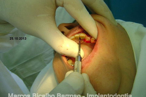 Regeneração Óssea Guiada com Osso Autógeno + Xenógeno + Tela de Titânio