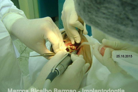 Regeneração Óssea Guiada com Osso Autógeno + Xenógeno + Tela de Titânio