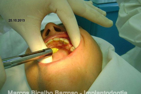 Regeneração Óssea Guiada com Osso Autógeno + Xenógeno + Tela de Titânio