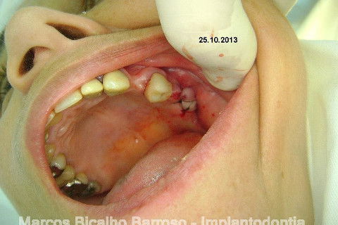 Regeneração Óssea Guiada com Osso Autógeno + Xenógeno + Tela de Titânio