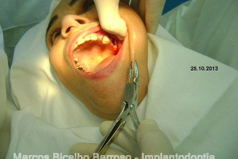 Regeneração Óssea Guiada com Osso Autógeno + Xenógeno + Tela de Titânio