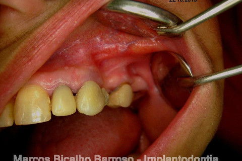 Regeneração Óssea Guiada com Osso Autógeno + Xenógeno + Tela de Titânio
