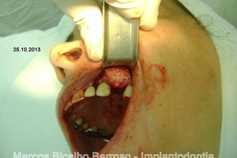 Regeneração Óssea Guiada com Osso Autógeno + Xenógeno + Tela de Titânio