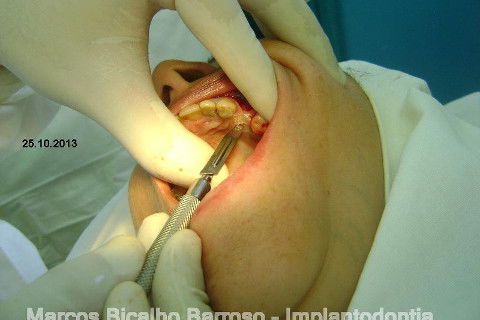 Regeneração Óssea Guiada com Osso Autógeno + Xenógeno + Tela de Titânio