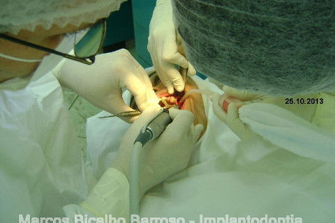 Regeneração Óssea Guiada com Osso Autógeno + Xenógeno + Tela de Titânio