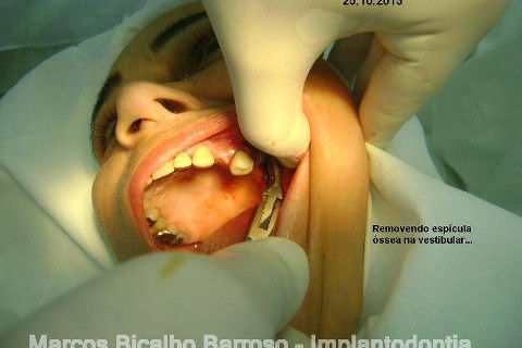 Regeneração Óssea Guiada com Osso Autógeno + Xenógeno + Tela de Titânio