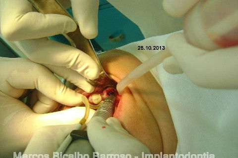 Regeneração Óssea Guiada com Osso Autógeno + Xenógeno + Tela de Titânio