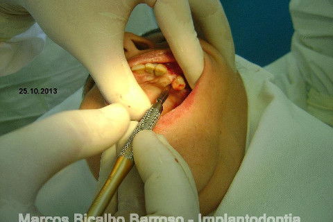 Regeneração Óssea Guiada com Osso Autógeno + Xenógeno + Tela de Titânio