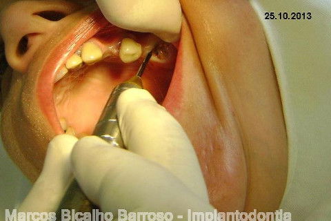 Regeneração Óssea Guiada com Osso Autógeno + Xenógeno + Tela de Titânio