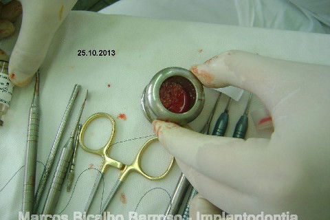 Regeneração Óssea Guiada com Osso Autógeno + Xenógeno + Tela de Titânio