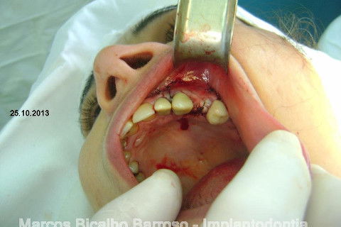 Regeneração Óssea Guiada com Osso Autógeno + Xenógeno + Tela de Titânio