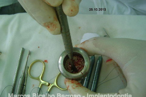 Regeneração Óssea Guiada com Osso Autógeno + Xenógeno + Tela de Titânio