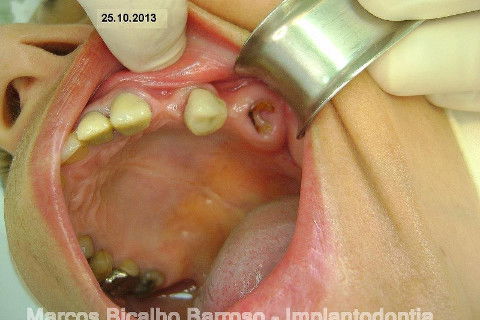 Regeneração Óssea Guiada com Osso Autógeno + Xenógeno + Tela de Titânio