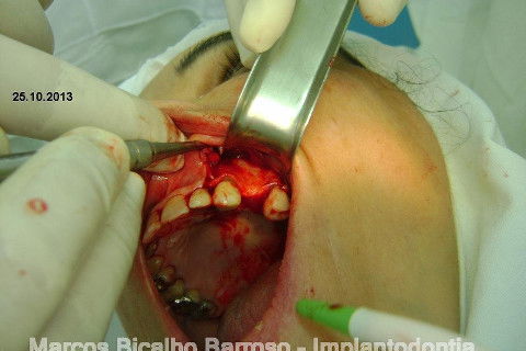 Regeneração Óssea Guiada com Osso Autógeno + Xenógeno + Tela de Titânio