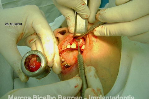 Regeneração Óssea Guiada com Osso Autógeno + Xenógeno + Tela de Titânio