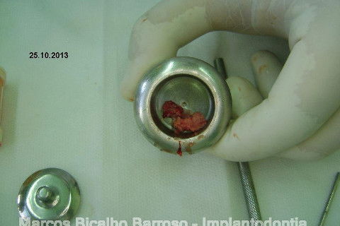 Regeneração Óssea Guiada com Osso Autógeno + Xenógeno + Tela de Titânio