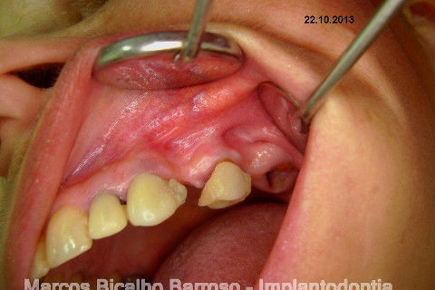 Regeneração Óssea Guiada com Osso Autógeno + Xenógeno + Tela de Titânio