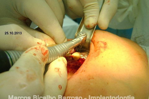 Regeneração Óssea Guiada com Osso Autógeno + Xenógeno + Tela de Titânio