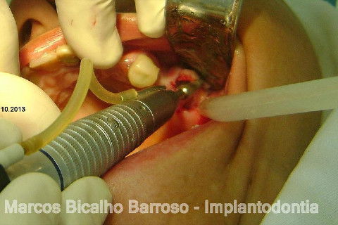 Regeneração Óssea Guiada com Osso Autógeno + Xenógeno + Tela de Titânio