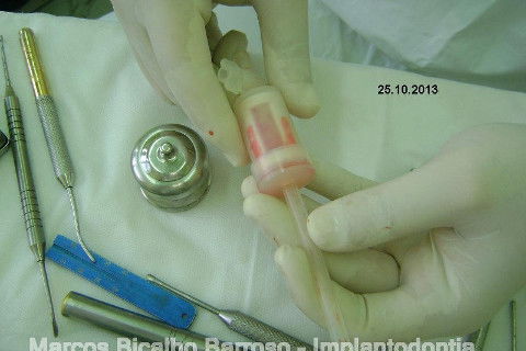 Regeneração Óssea Guiada com Osso Autógeno + Xenógeno + Tela de Titânio