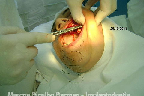 Regeneração Óssea Guiada com Osso Autógeno + Xenógeno + Tela de Titânio