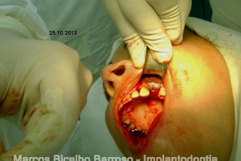 Regeneração Óssea Guiada com Osso Autógeno + Xenógeno + Tela de Titânio