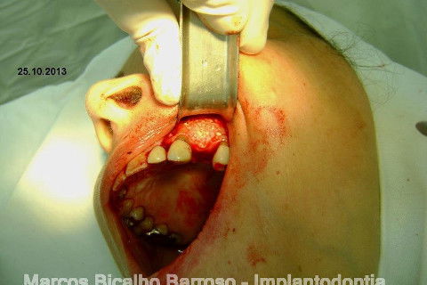 Regeneração Óssea Guiada com Osso Autógeno + Xenógeno + Tela de Titânio