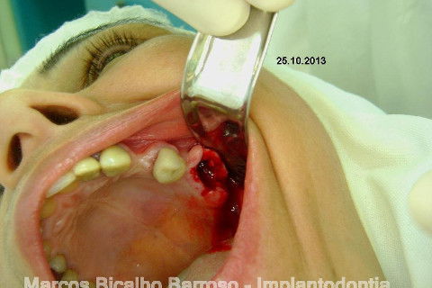 Regeneração Óssea Guiada com Osso Autógeno + Xenógeno + Tela de Titânio
