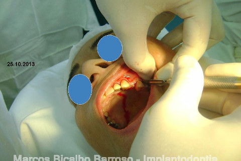 Regeneração Óssea Guiada com Osso Autógeno + Xenógeno + Tela de Titânio